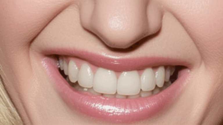 Did Rebel Wilson Get Veneers Analyzing Her Radiant Dental Transformation