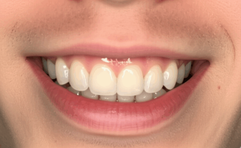 Did Ryan Trahan Get Veneers Unpacking the Truth Behind His Evolving Smile