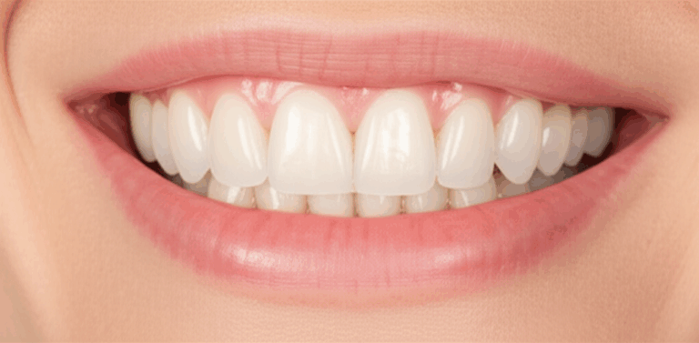 Do Clip On Veneers Look Real An Honest Look at Aesthetics Pros Cons