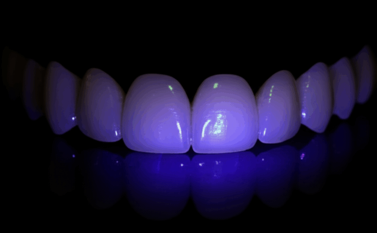 Do Porcelain Veneers Glow Under Blacklight What I Learned as a Patient and Cosmetic Dentistry Enthusiast