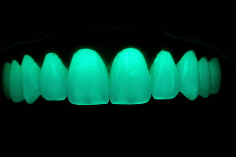 Do Veneers Glow in the Dark Understanding Light Aesthetics and Your Smile
