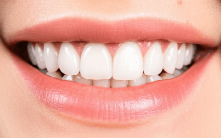Do Veneers Make Your Teeth Whiter My Personal Guide to a Brighter Smile