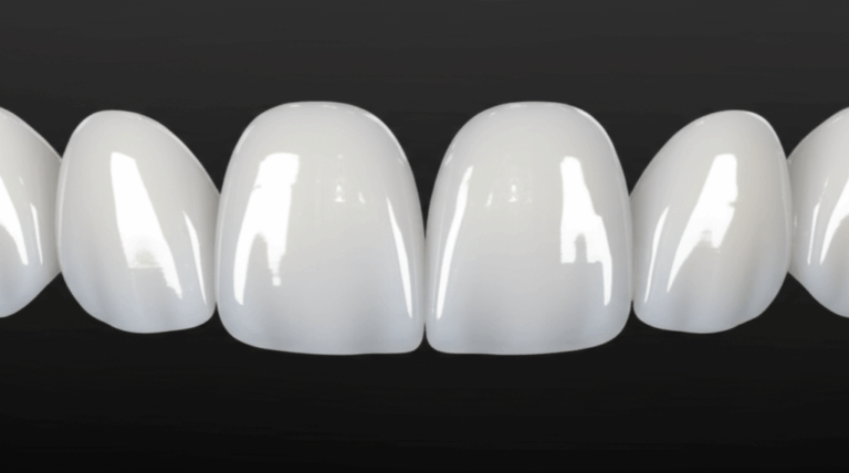 Do Veneers Stain Easily My First Hand Guide to Stain Resistance and Prevention