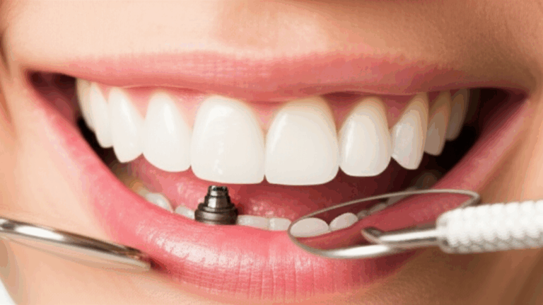 How Much Do Dental Implants Cost in Canada 2024 Price Guide