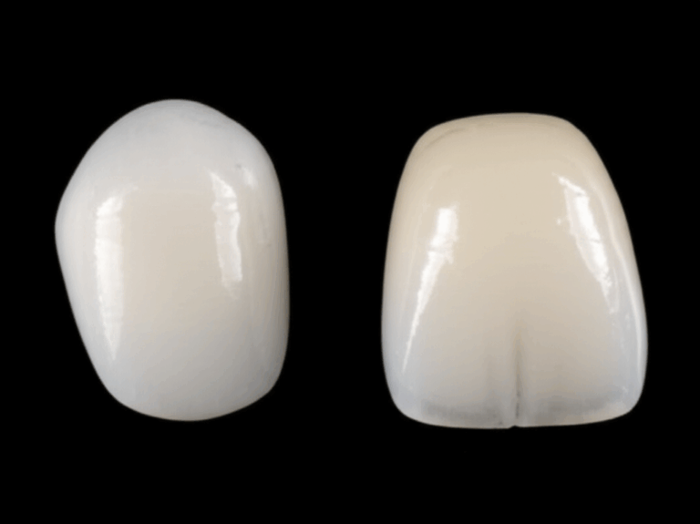 Veneers vs. Crowns My Straight Talk Guide to Choosing the Best Dental Fix for You