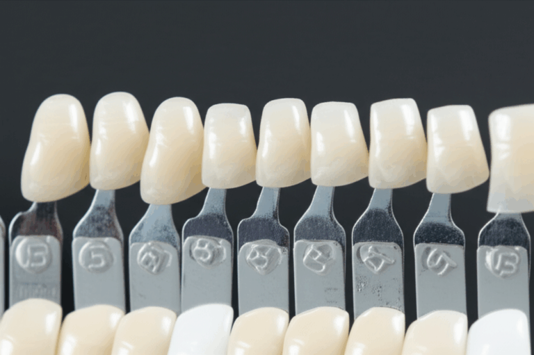 What Are Different Types of Veneers A Simple Guide to Your Smile Choices
